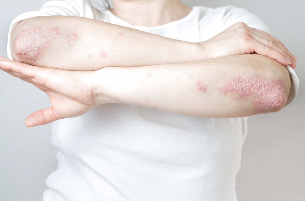 Psoriasis Pustular Generalizada