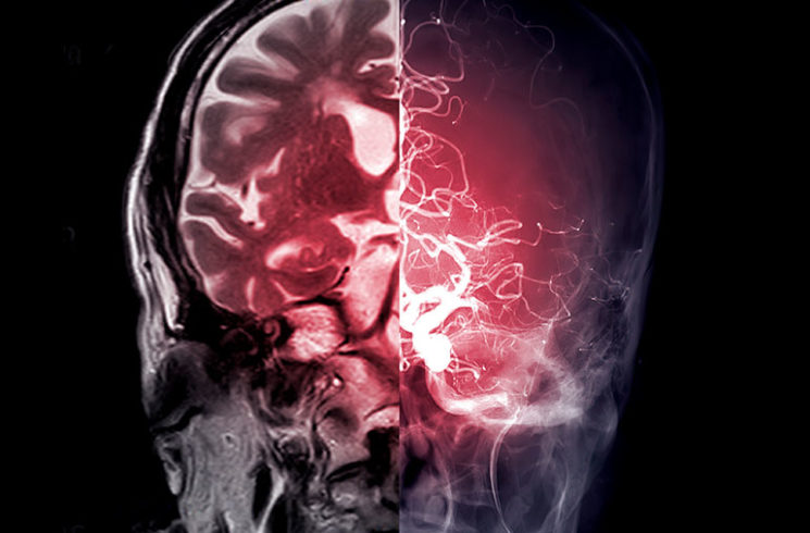 Estimulación Cerebral Profunda