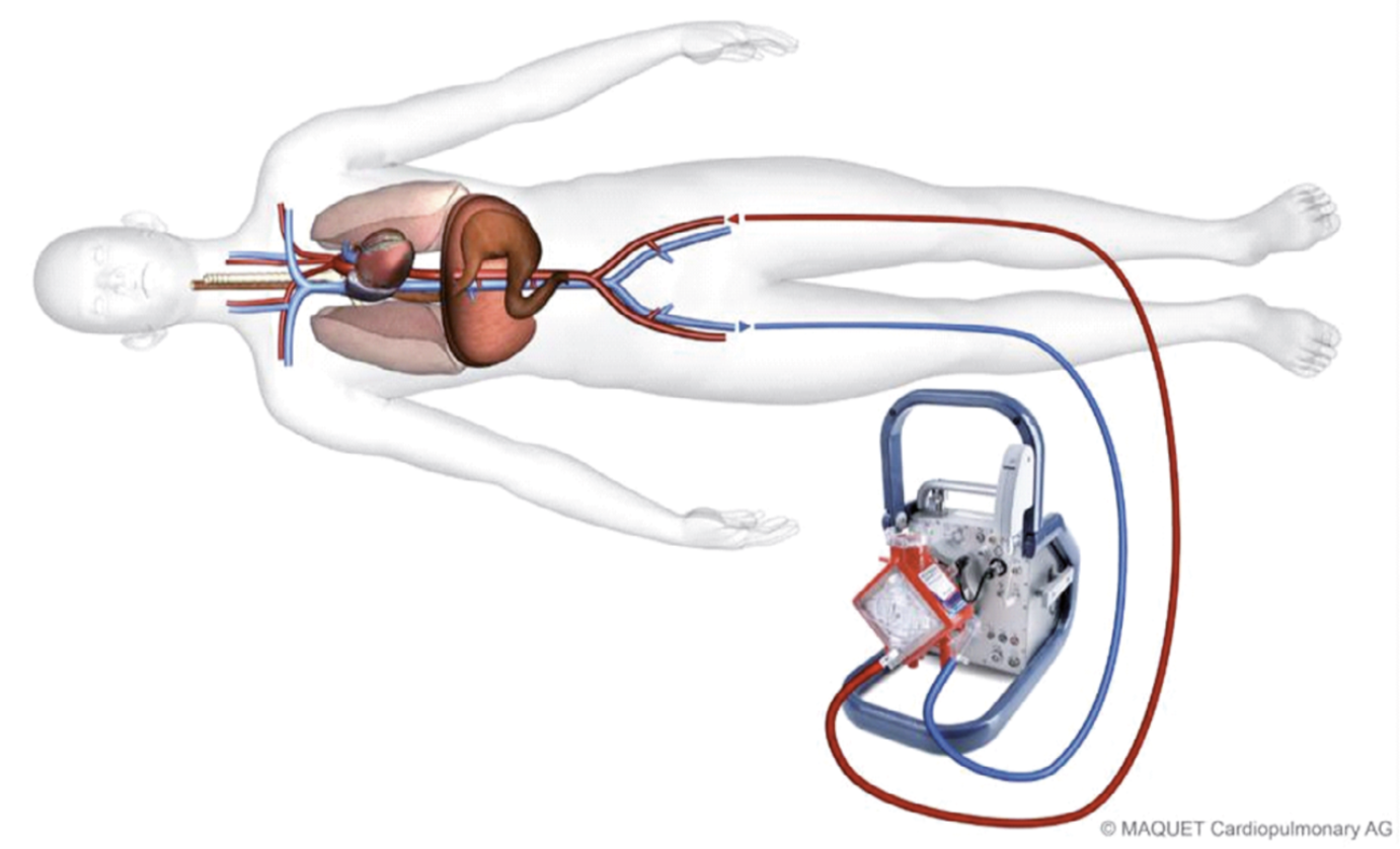 Подключение человеку. Экстракорпоральная мембранная оксигенация. Аппарат искусственного кровообращения ЭКМО. Maquet аппарат ЭКМО. Аппараты для ЭКМО (экстракорпоральной мембранной оксигенации)..
