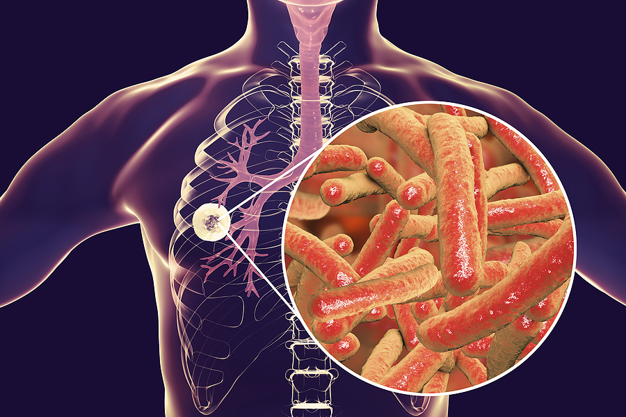 Día Mundial contra la Tuberculosis 2024. ¿Por qué se conmemora el 24 de marzo?