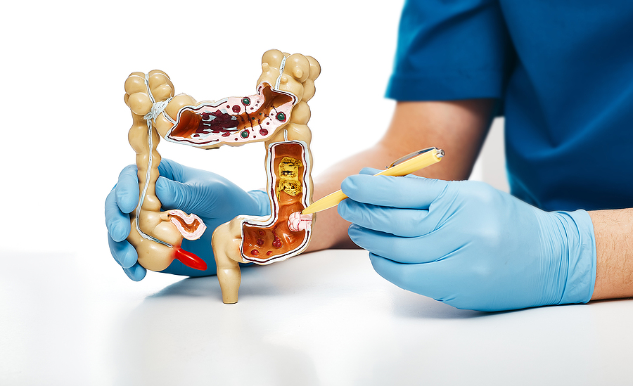 Cáncer colorrectal, ¿por qué cada vez hay más casos en menores de 30 años?