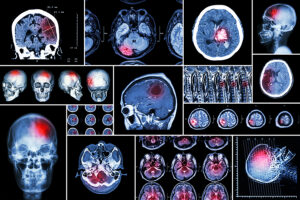 Las 10 enfermedades neurológicas que más afectan en la calidad de vida