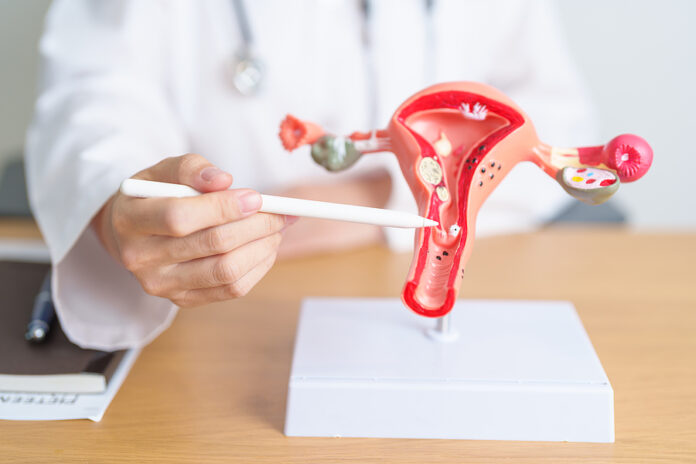 Cáncer de ovario: Hasta 9 de cada 10 casos pueden ser curables