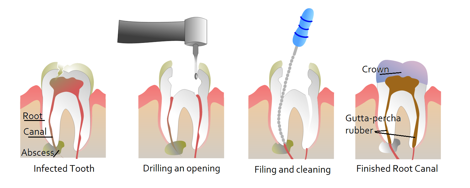 rootcanalsteps