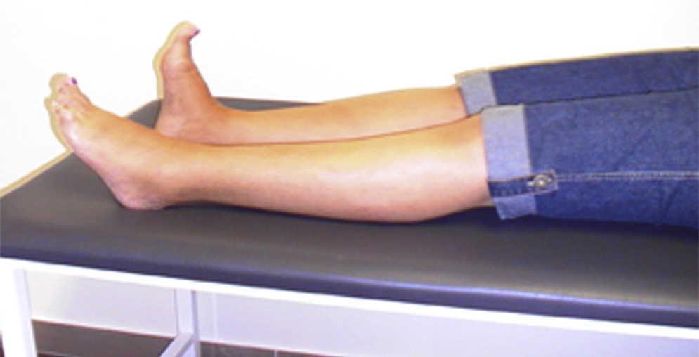 Focal gradual-onset variant of stiff-person syndrome