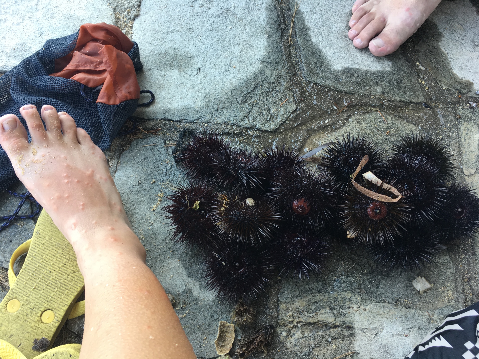 mosquito-bites-and-sea-urchins