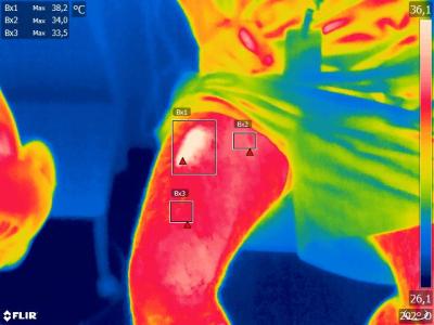 Infrared image of the heating of the skin by a Class IV Laser in dark pigmented skin.