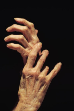 Hands with Arthritis