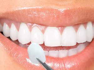 Crowns and Veneers