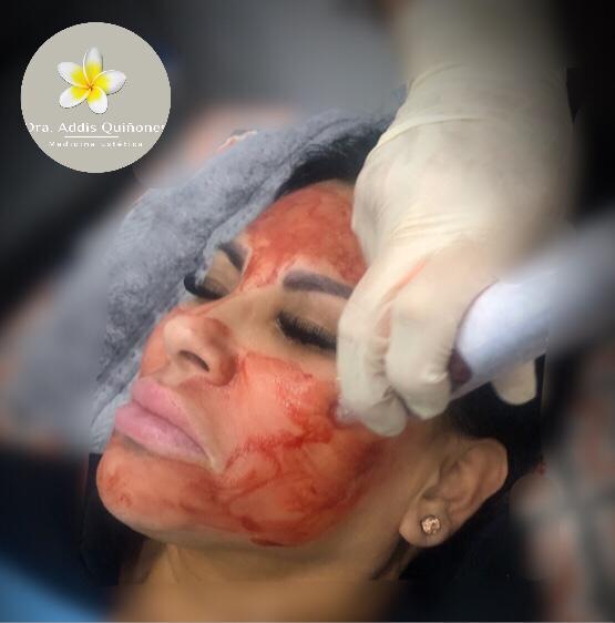 Vampire Facial (PRP)