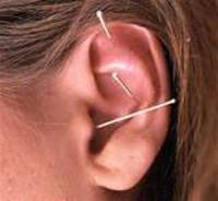 Ear Acupuncture