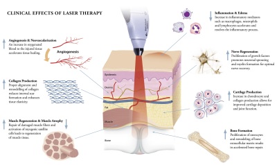 Laser Treatment