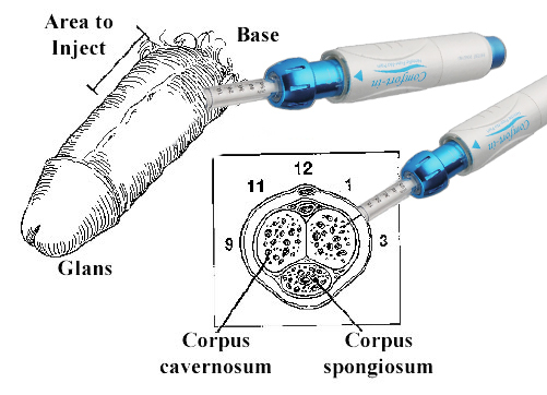 Needle Penis