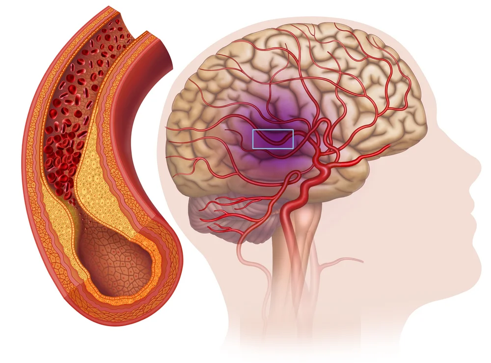 Nventric ULTRIVA neurovascular thrombectomy device for ischemic stroke