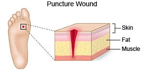 Puncture Wound - What You Need to Know