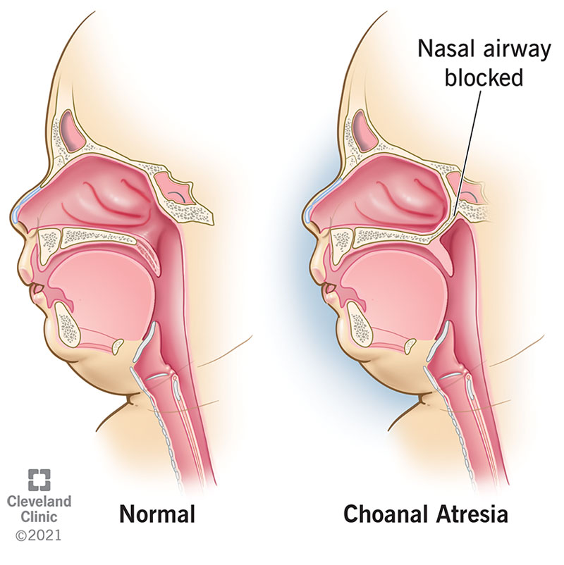 Choanal Atresia: What it Is, Symptoms, Treatment & Repair