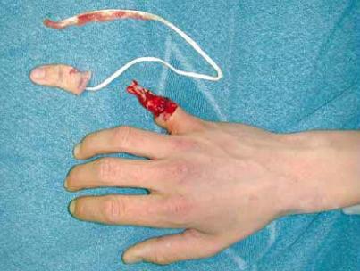 Ring Avulsion Injuries - Hand - Orthobullets