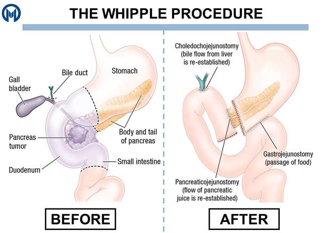 Pancreatic Cancer Surgery and Whipple Procedure – Pancreatica.org