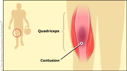 Quadriceps Contusion (for Teens) - Nemours KidsHealth