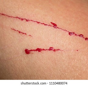 Pain Itching Wound Scratches Drops Blood Stock Photo 1110480074 | Shutterstock