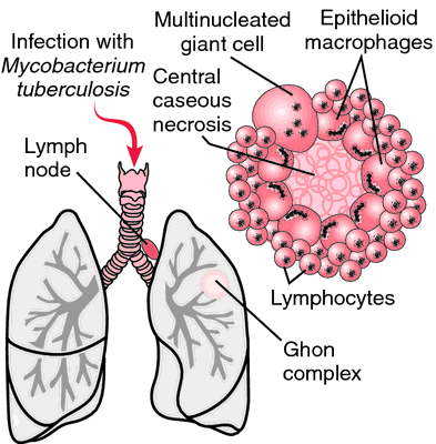 Tuberculosis-->POTT SYNDROME. The Ghon complex, typical of pulmonary tuberculosis, consists of a parenchyma… | Medical dictionary, Respiratory therapy, Nursing tips