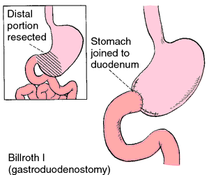 Billroth Surgery ~ Nursing Path