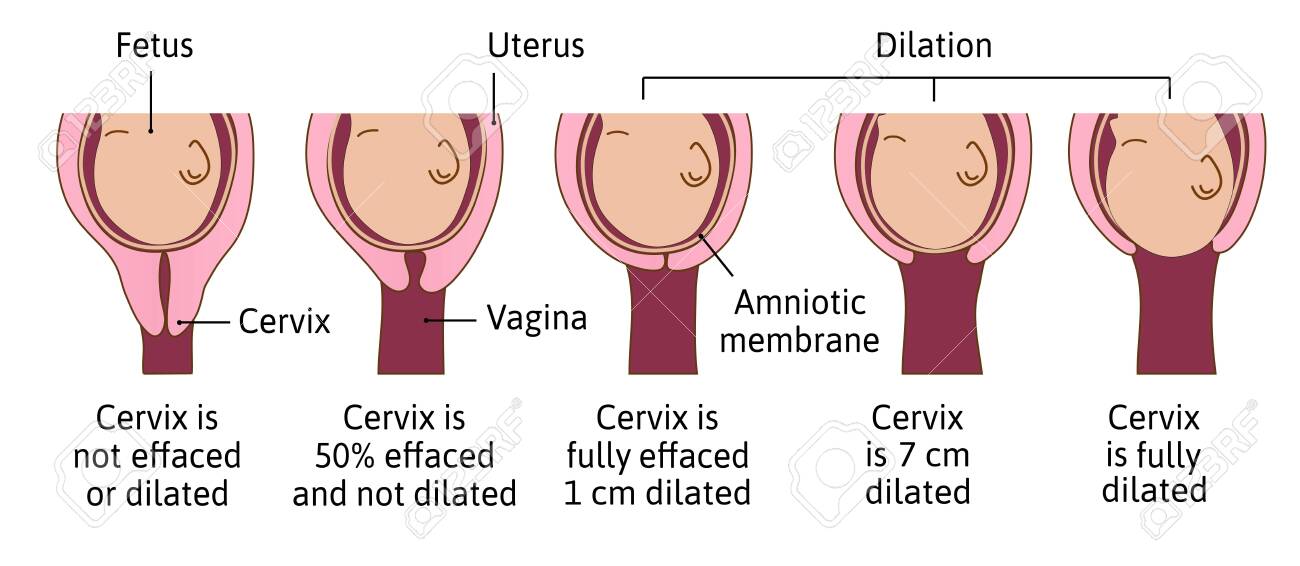 Cervical Effacement And Dilation During Labor Or Delivery. Cervix Changes From Not Effaced And Dilated To Fully Effaced And Totally Dilated. Vector Medical Illustration. Royalty Free Cliparts, Vectors, And Stock Illustration. Image