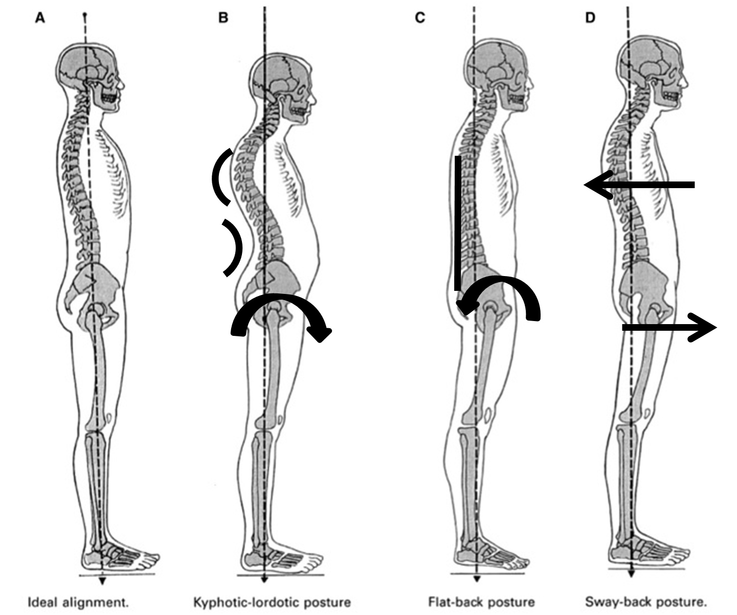 Posture Types, How To Improve Posture