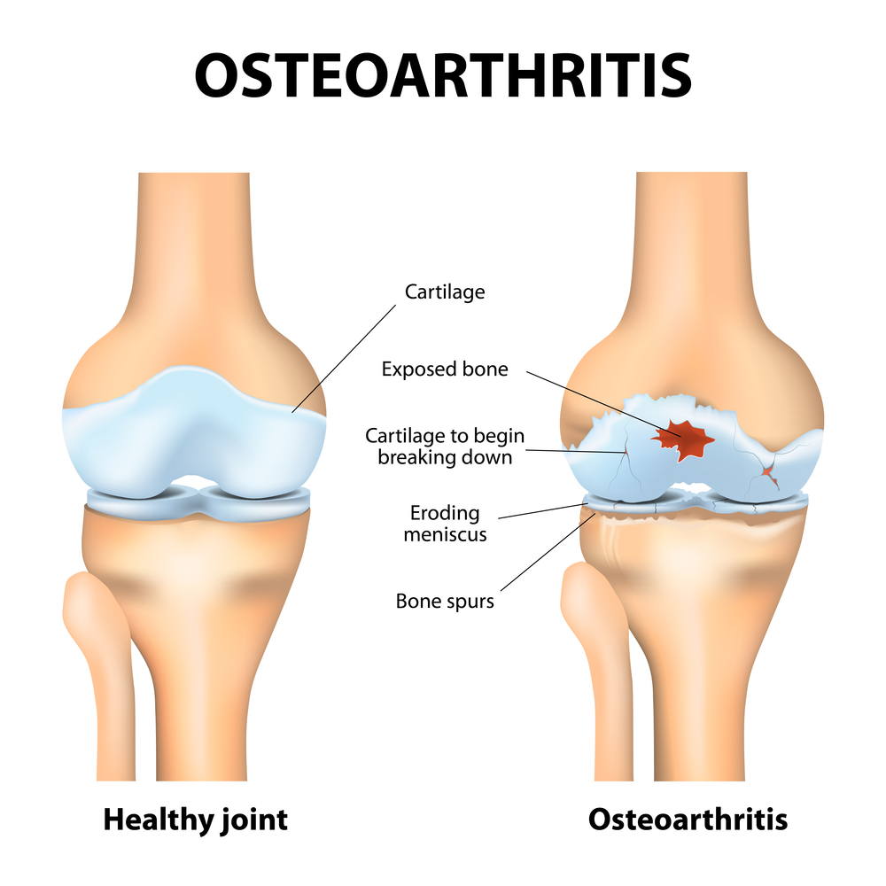 Exercises for Knee Osteo-arthritis