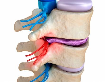 What is a disc prolapse?