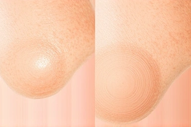 Skin texture comparison, facial and body exfoliation results